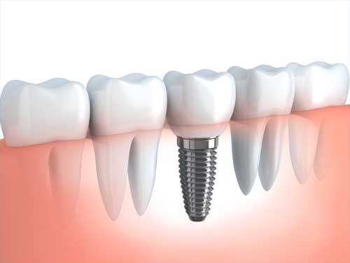 teeth implants