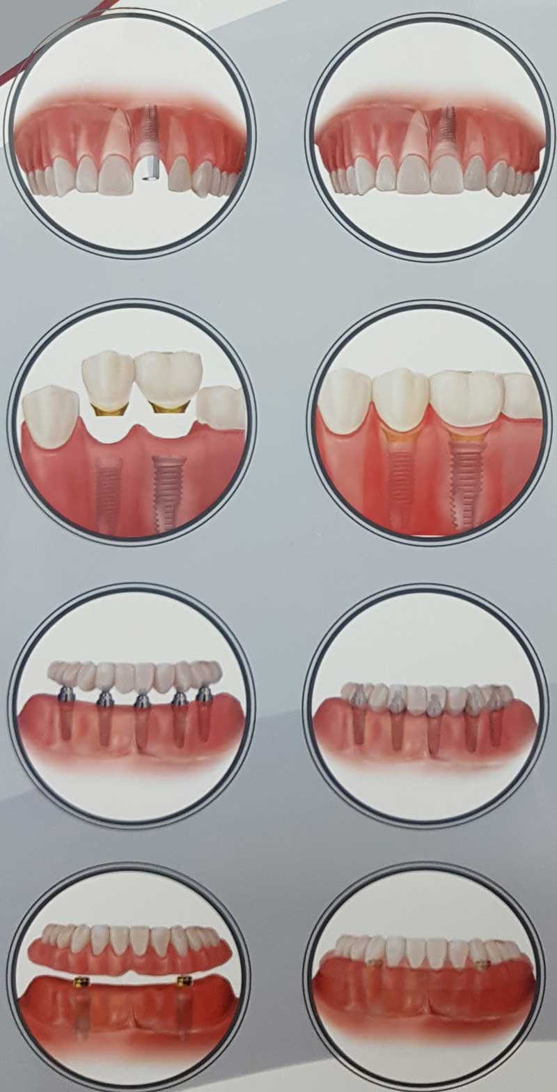 teeth implants