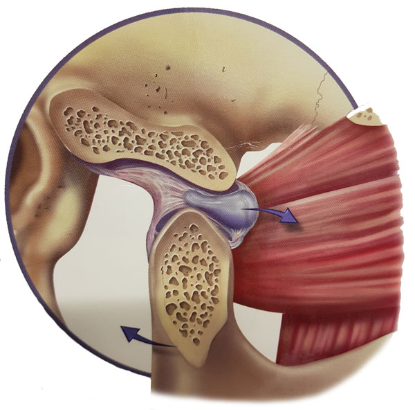 jaw pain