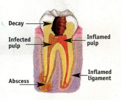 root canal