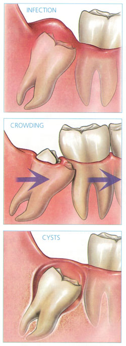 wisdom teeth